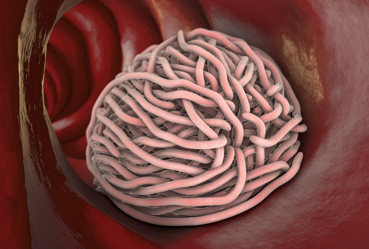 Mrľa detská: Príznaky, test, a liečba